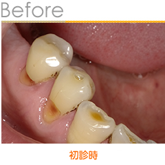 吉川市の歯科医院 ニーズ歯科の症例のご紹介です 18年6月の症例です